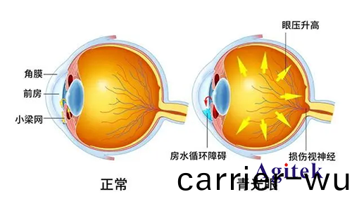 TH2851係列(lie)高(gao)精密(mi)阻抗分(fen)析(xi)儀(yi)在(zai)新(xin)型(xing)眼科中的應(ying)用(圖(tu)1)